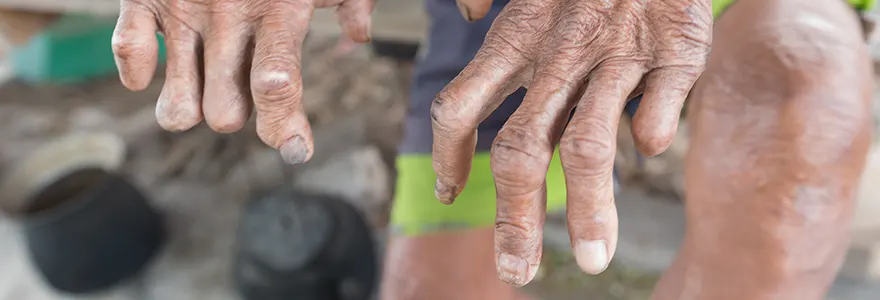 La lèpre, une maladie qui ne cesse de perdurer